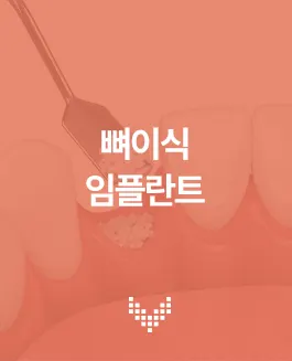 뼈이식 임플란트