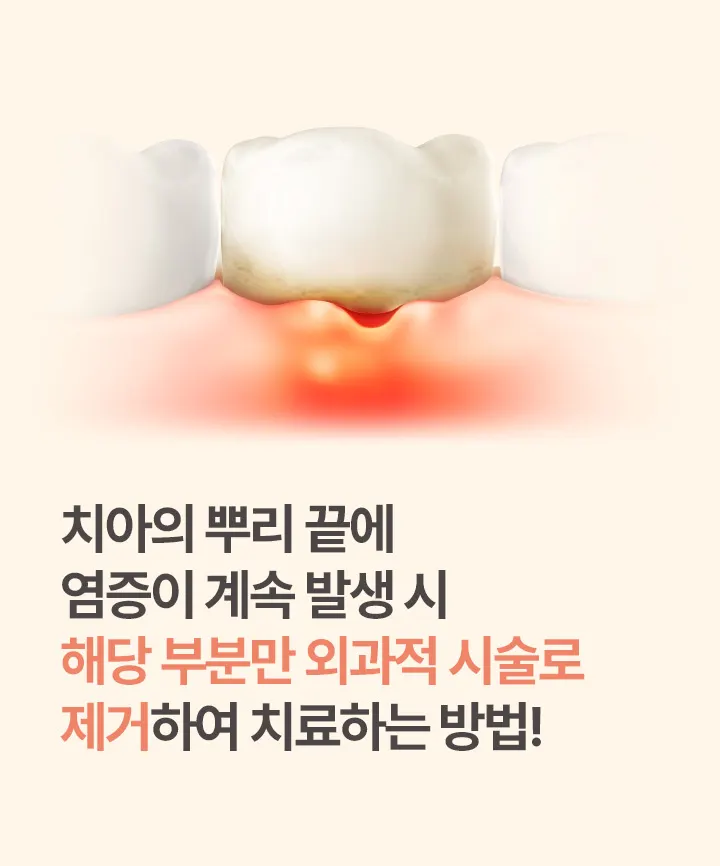 치아의 뿌리 끝에 염증이 계속 발생 시 해당 부분만 외과적 시술로 제거하여 치료하는 방법!
