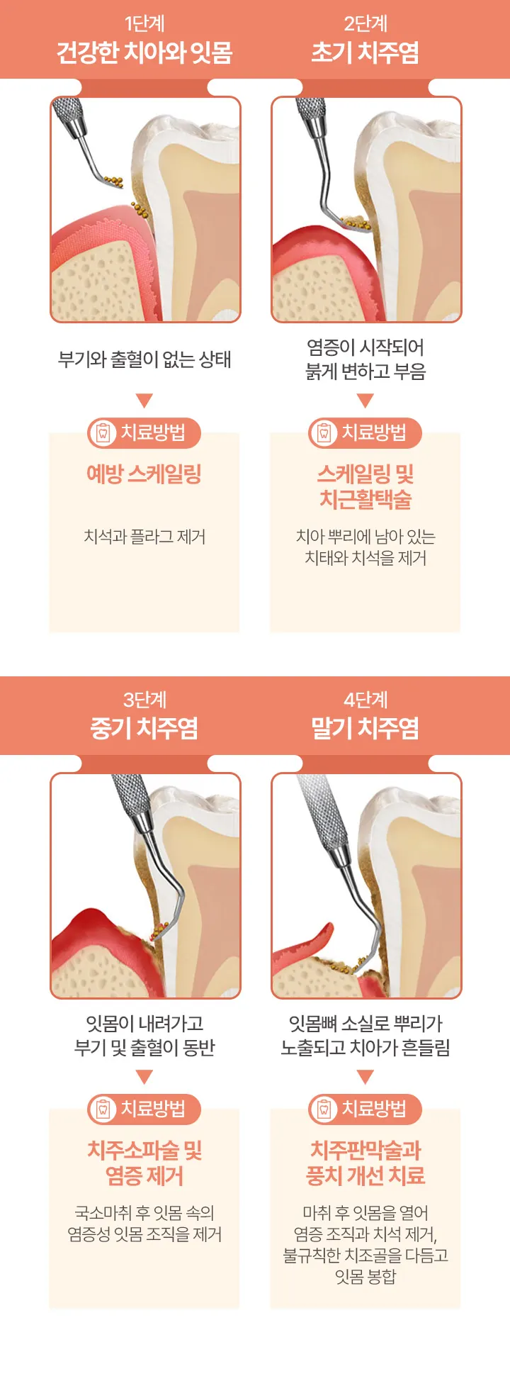 건강한 치아와 잇몸 > 초기 치주염 > 중기 치주염 > 말기 치주염
