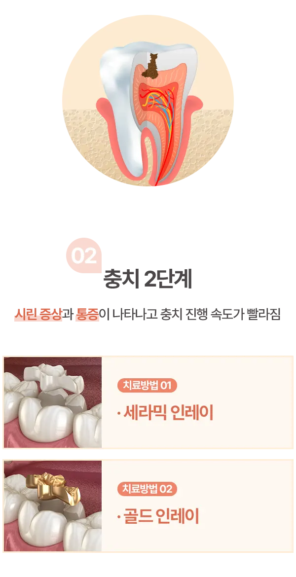 충치 2단계