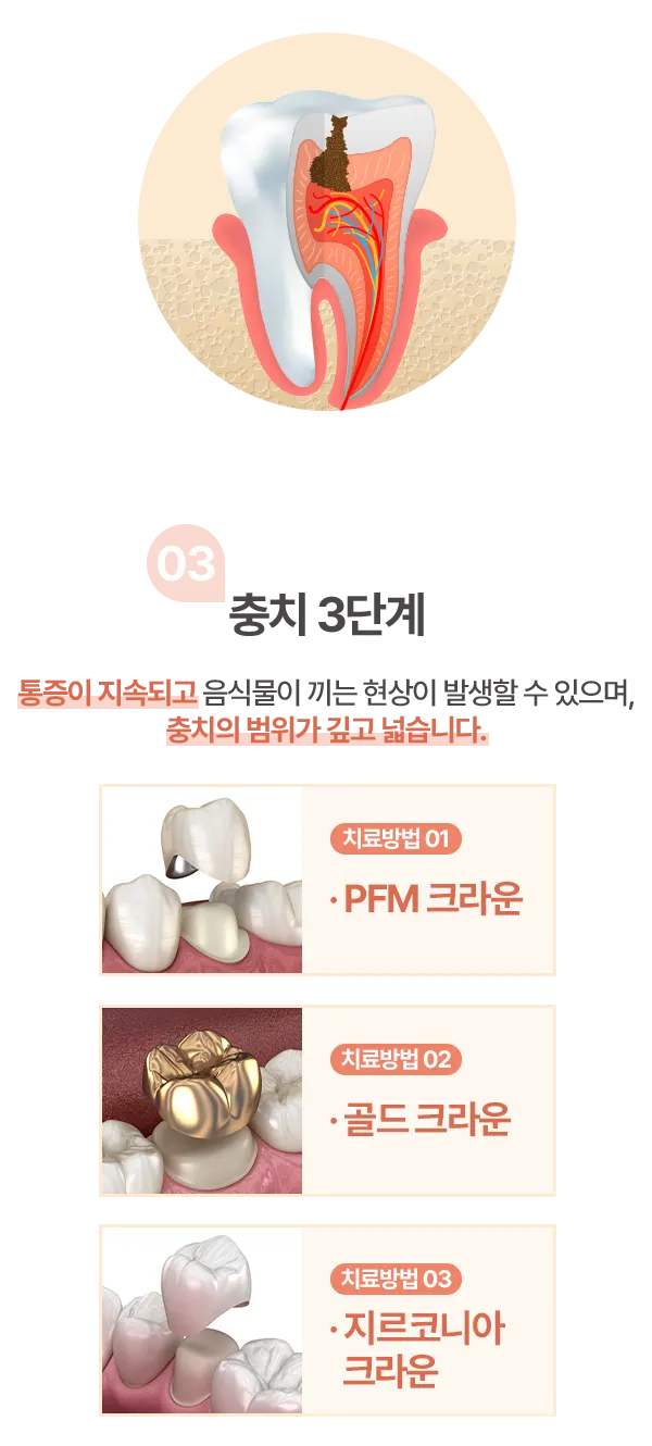 충치 3단계