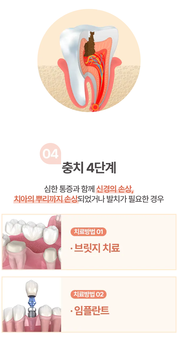 충치 4단계