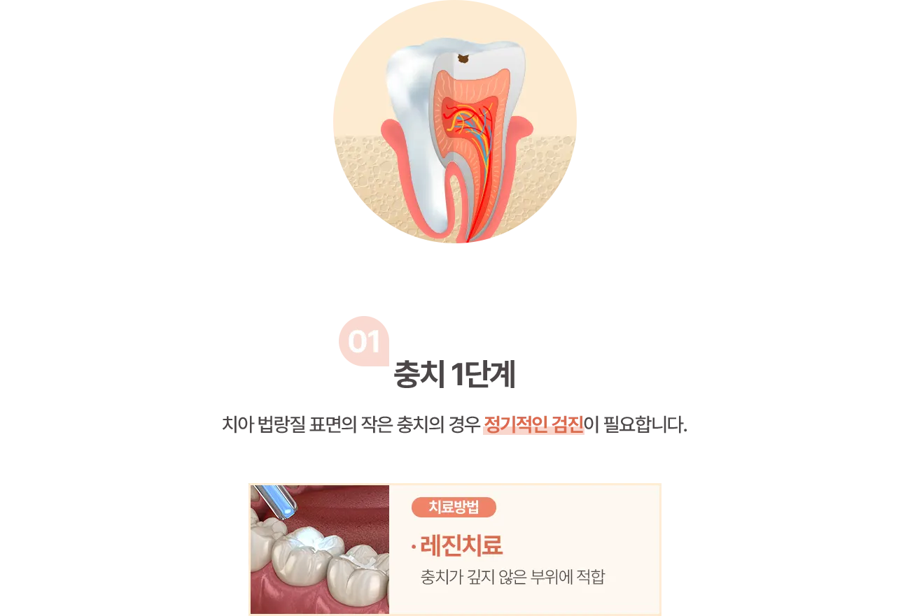 충치 1단계