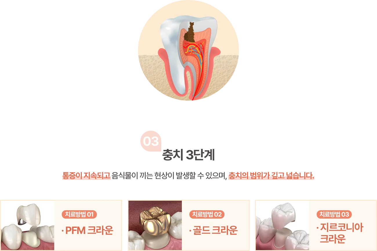 충치 3단계