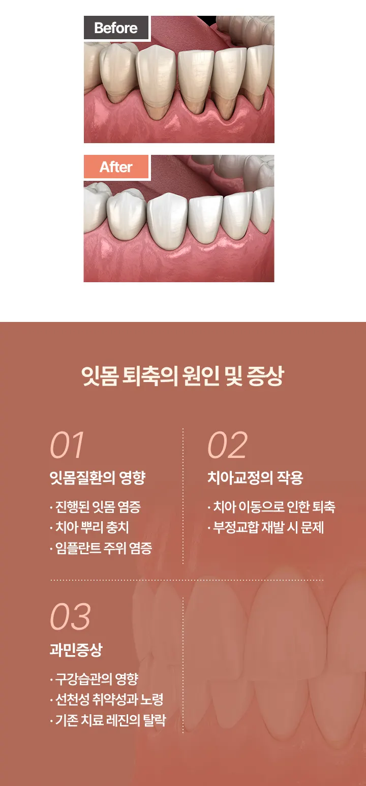 잇몸 퇴축의 원인 및 증상