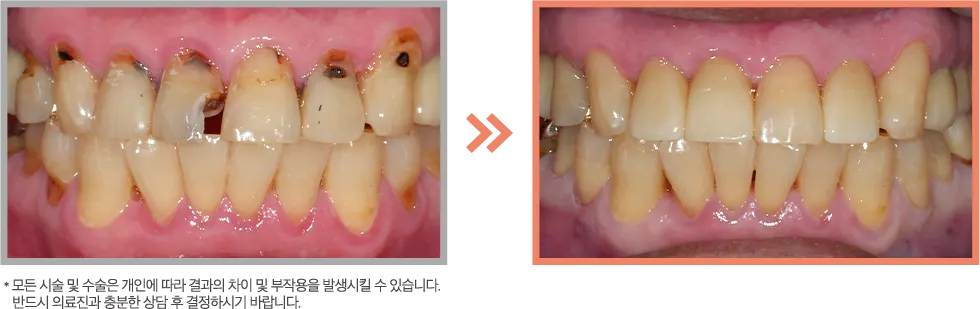 앞니 레진 증례