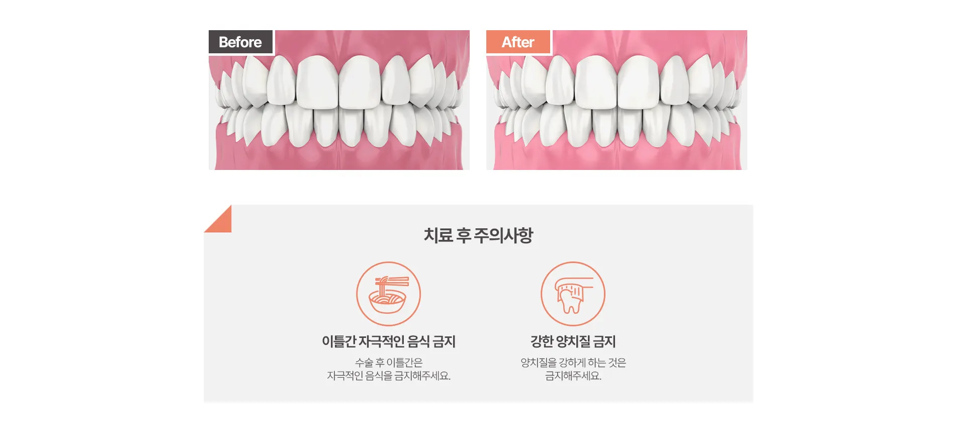 잇몸(치은)미백