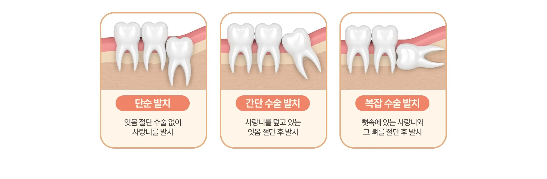 단순 발치 | 간단 수술 발치 | 복잡 수술 발치